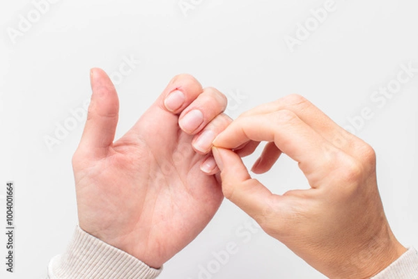 Fototapeta Closeup of hands with deformed nails and torn, ripped and picked on cuticle skin peeling off from human nail biting behavior