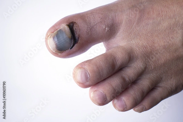 Obraz Toe injury