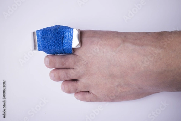 Fototapeta Phalanx fracture with splint and elastic gauze