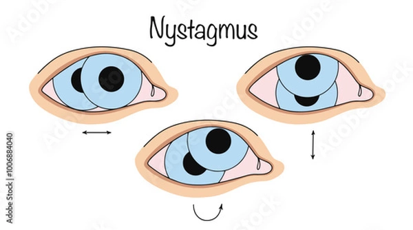 Obraz Nystagmus