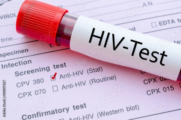 Fototapeta HIV infection screening test form.
