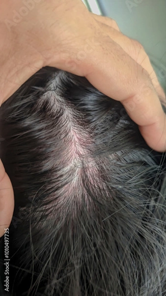Obraz Close up of a child's scalp, with red and irritated skin.