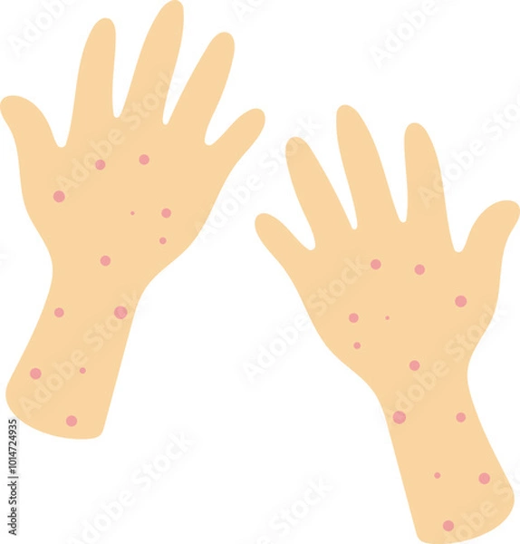 Fototapeta Hand rashes illustration