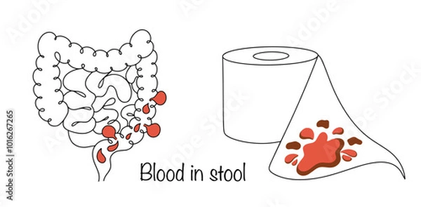 Obraz Blood in stool