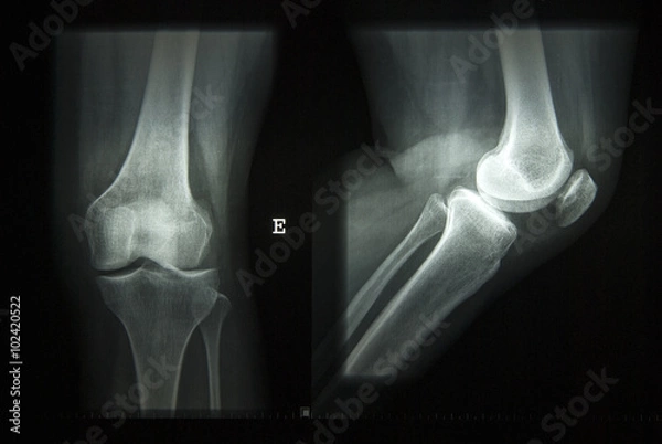 Obraz zdjęcie rentgenowskie normalne kolano