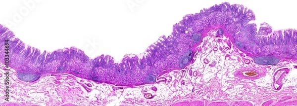 Obraz Przewlekłe zapalenie żołądka człowieka