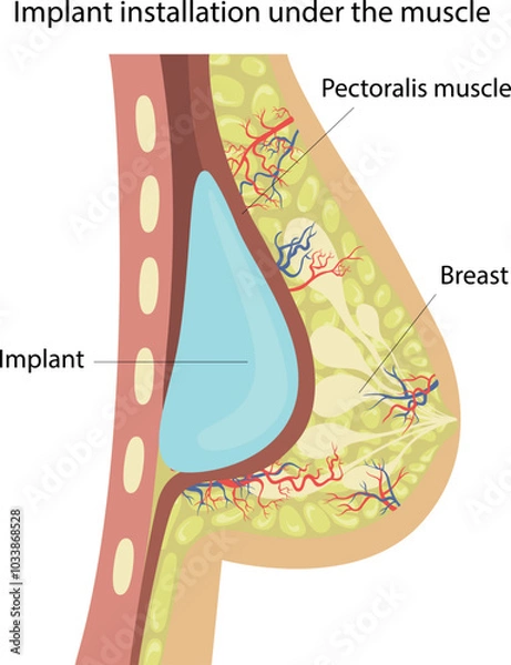 Fototapeta Breast augmentation with implants.