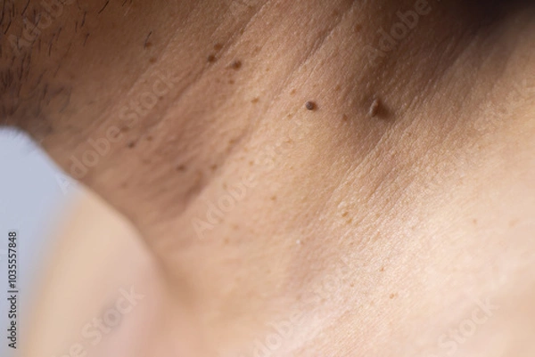 Obraz Skin tags or soft tissue tumors that are a skin problem on the neck