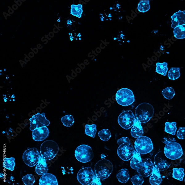 Obraz Leukemic cells labeled with fluorescent molecules