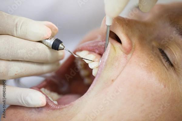 Obraz Periodontal probe for measuring pocket depths