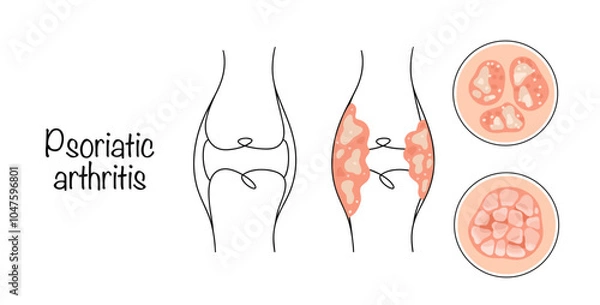 Obraz Psoriatic arthritis