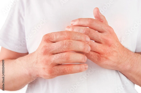 Obraz Man scratches or shows hands with dry, cracked skin on white backgrounds. Problem with many people - eczema on hand, allergies or dry skin. Health care concept. Close up.