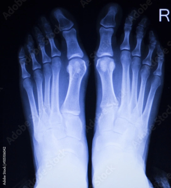 Obraz Foot and toes injury xray scan