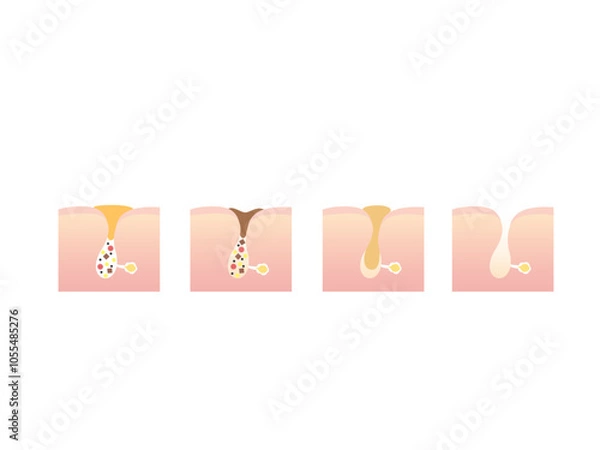 Obraz 毛穴汚れのイラスト