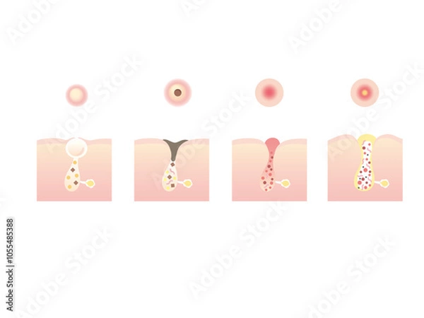 Obraz ニキビのイラスト