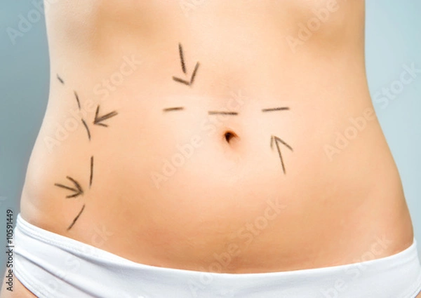 Obraz Marked abdomen for cosmetic surgery