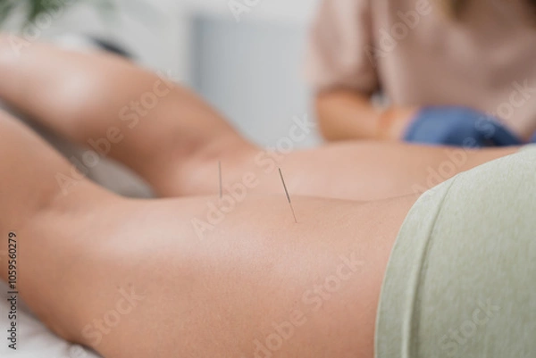 Obraz Physiotherapist applying acupuncture needles to patient's leg for pain relief