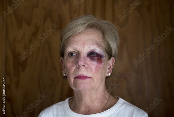 Fototapeta Portrait image of a mature woman with a bruised eye, with copy space.