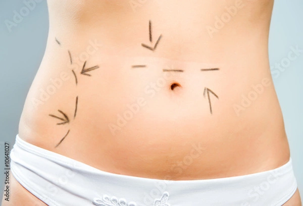 Obraz Drawn abdomen for plastic surgery