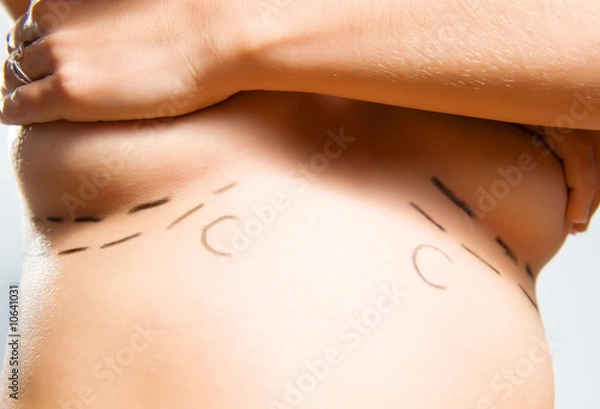 Obraz Marks under breasts for cosmetic surgery