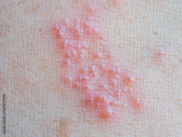 Fototapeta Shingles (Herpes Zoster, Shingles) is a type of skin disease. This is caused by the Varicella Zoster Virus,. Causes inflammation of the nerves burning pain and a rash along the nerves.