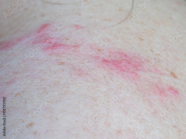 Fototapeta Shingles (Herpes Zoster, Shingles) is a type of skin disease. This is caused by the Varicella Zoster Virus,. Causes inflammation of the nerves burning pain and a rash along the nerves.