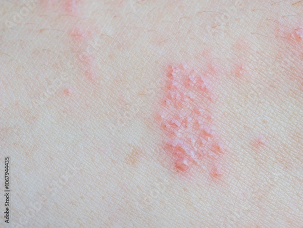 Fototapeta Shingles (Herpes Zoster, Shingles) is a type of skin disease. This is caused by the Varicella Zoster Virus,. Causes inflammation of the nerves burning pain and a rash along the nerves.
