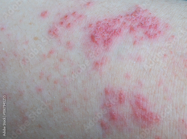 Fototapeta Shingles (Herpes Zoster, Shingles) is a type of skin disease. This is caused by the Varicella Zoster Virus,. Causes inflammation of the nerves burning pain and a rash along the nerves.