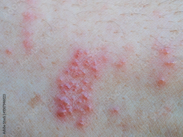 Fototapeta Shingles (Herpes Zoster, Shingles) is a type of skin disease. This is caused by the Varicella Zoster Virus,. Causes inflammation of the nerves burning pain and a rash along the nerves.