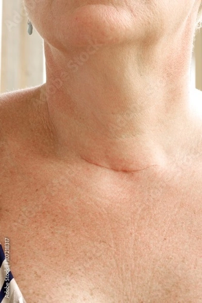 Obraz Neck scar after thyroidectomy.Closeup