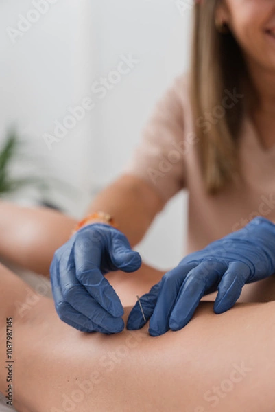 Obraz Physiotherapist applying dry needling technique to patient's leg for pain relief