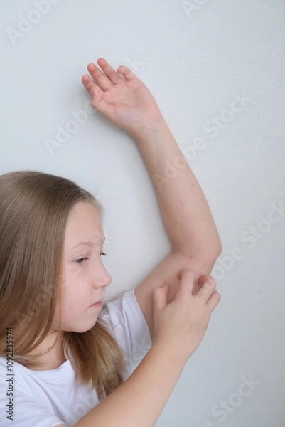 Obraz The child scratches atopic skin. Dermatitis, diathesis, allergy on the child's body.	