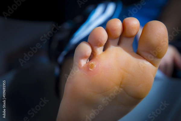 Obraz Calluses on foot