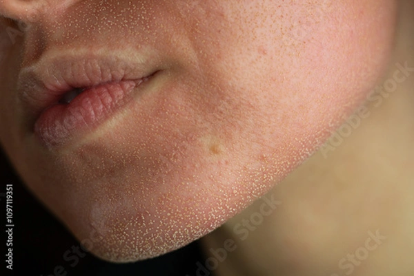 Fototapeta Close-up of skin after laser resurfacing – CO2 fractionated laser.