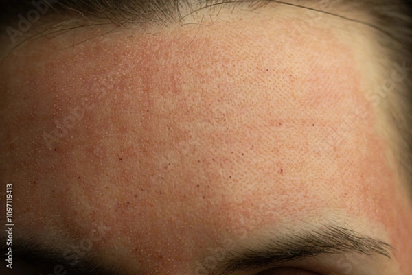 Fototapeta Close-up of skin after laser resurfacing – CO2 fractionated laser.