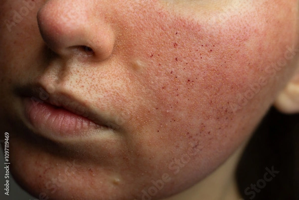 Fototapeta Close-up of skin after laser resurfacing – CO2 fractionated laser.