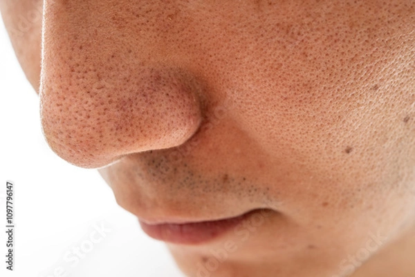 Obraz いちご鼻のクローズアップ：30代男性の毛穴と角栓