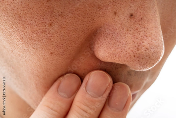 Obraz いちご鼻のクローズアップ：30代男性の毛穴と角栓