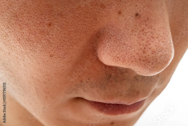 Obraz いちご鼻のクローズアップ：30代男性の毛穴と角栓