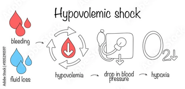Obraz Hypovolemic shock