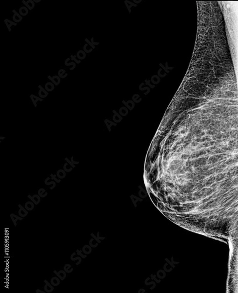Obraz Contrast-enhanced digital mammography