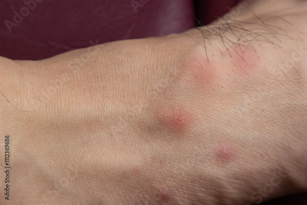 Fototapeta The blisters are red and itchy on the patient's skin that are caused by bites from pet fleas