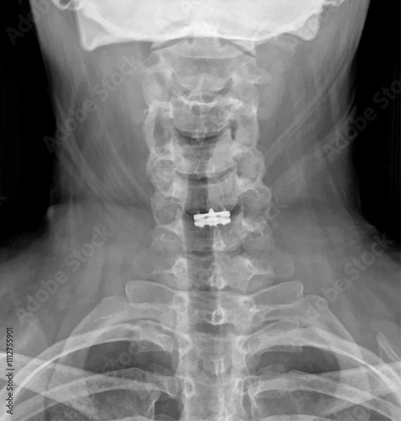 Fototapeta Neck X-ray of a patient undergoing Cervical Microdiscectomy and Cervical Disc Prosthesis for Medical Research and Teaching. Vector illustration. 