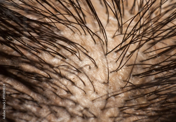 Fototapeta Dandruff on scalp and dark hair. Macro shot
