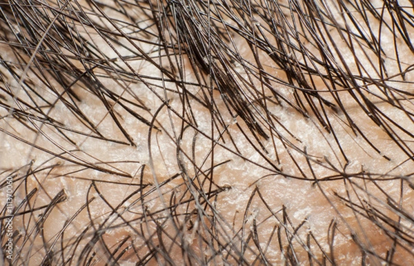 Fototapeta Dandruff on scalp and dark hair. Macro shot