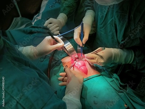 Fototapeta Surgery of abdominal, Resection of Small Bowels with Ligation of vessels during operation. Step by step surgery.