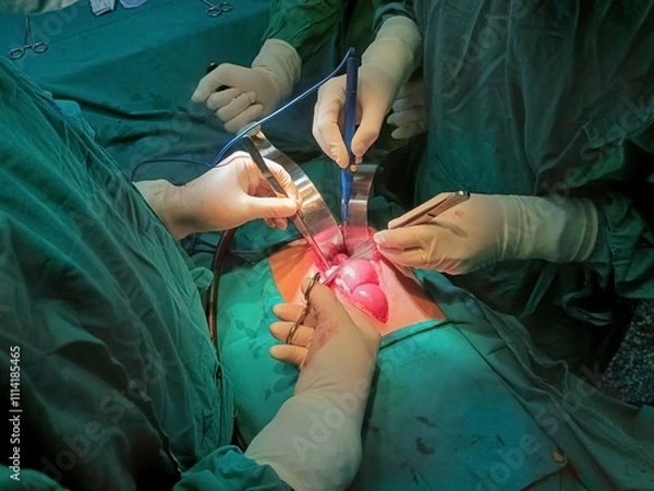 Fototapeta Surgery of abdominal, Resection of Small Bowels with Ligation of vessels during operation. Step by step surgery.