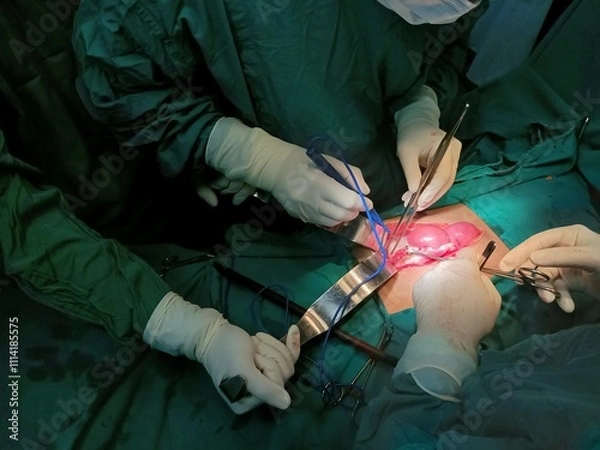 Fototapeta Surgery of abdominal, Resection of Small Bowels with Ligation of vessels during operation. Step by step surgery.