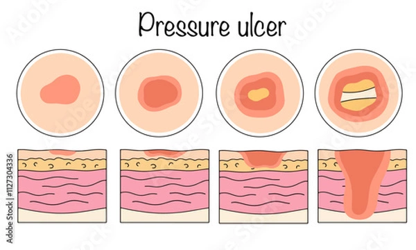 Obraz Pressure ulcer