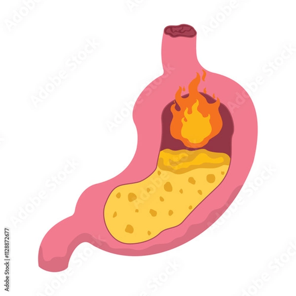 Obraz concept illustration of stomach ulcers, GERD, vector illustration.